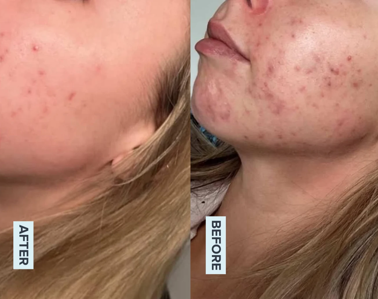 AlumierMD skin peel before and after at Beauty Studio MediSpa, Shenfield