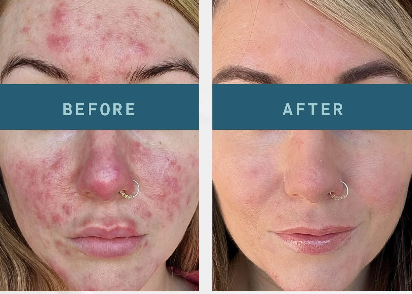 AlumierMD skin peel before and after at Beauty Studio MediSpa, Shenfield