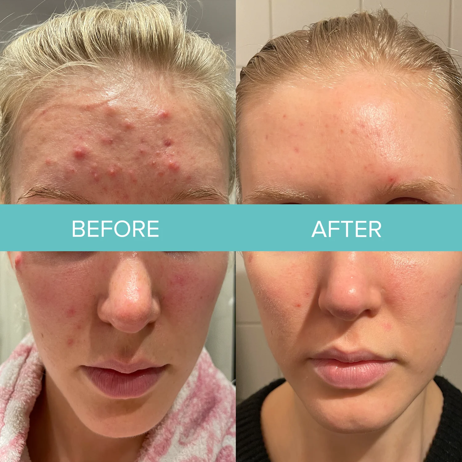 AlumierMD skin peel before and after at Beauty Studio MediSpa, Shenfield