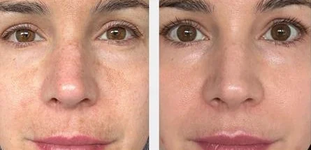 AlumierMD skin peel before and after at Beauty Studio MediSpa, Shenfield