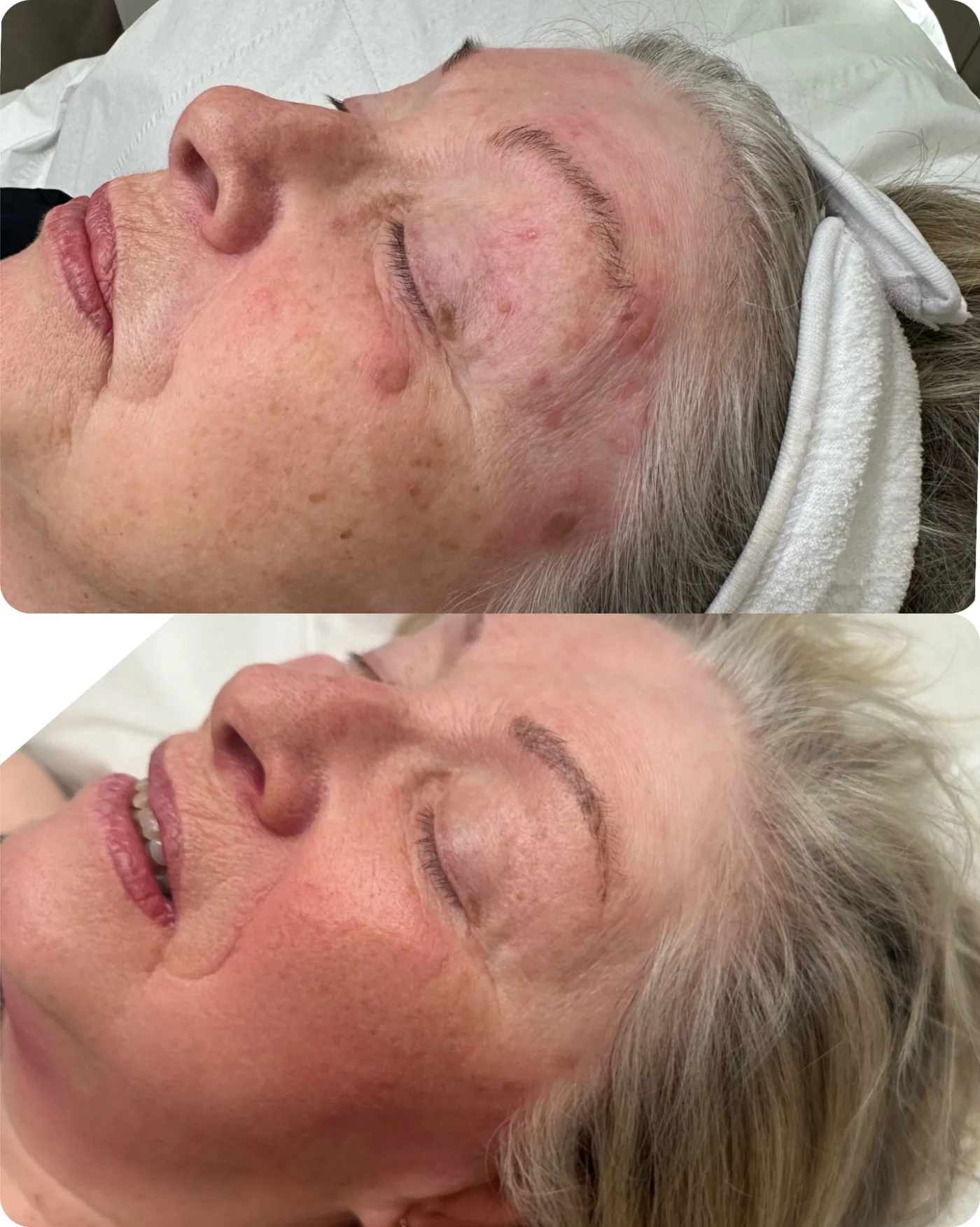 CryoPen before and after at Beauty Studio MediSpa, Shenfield
