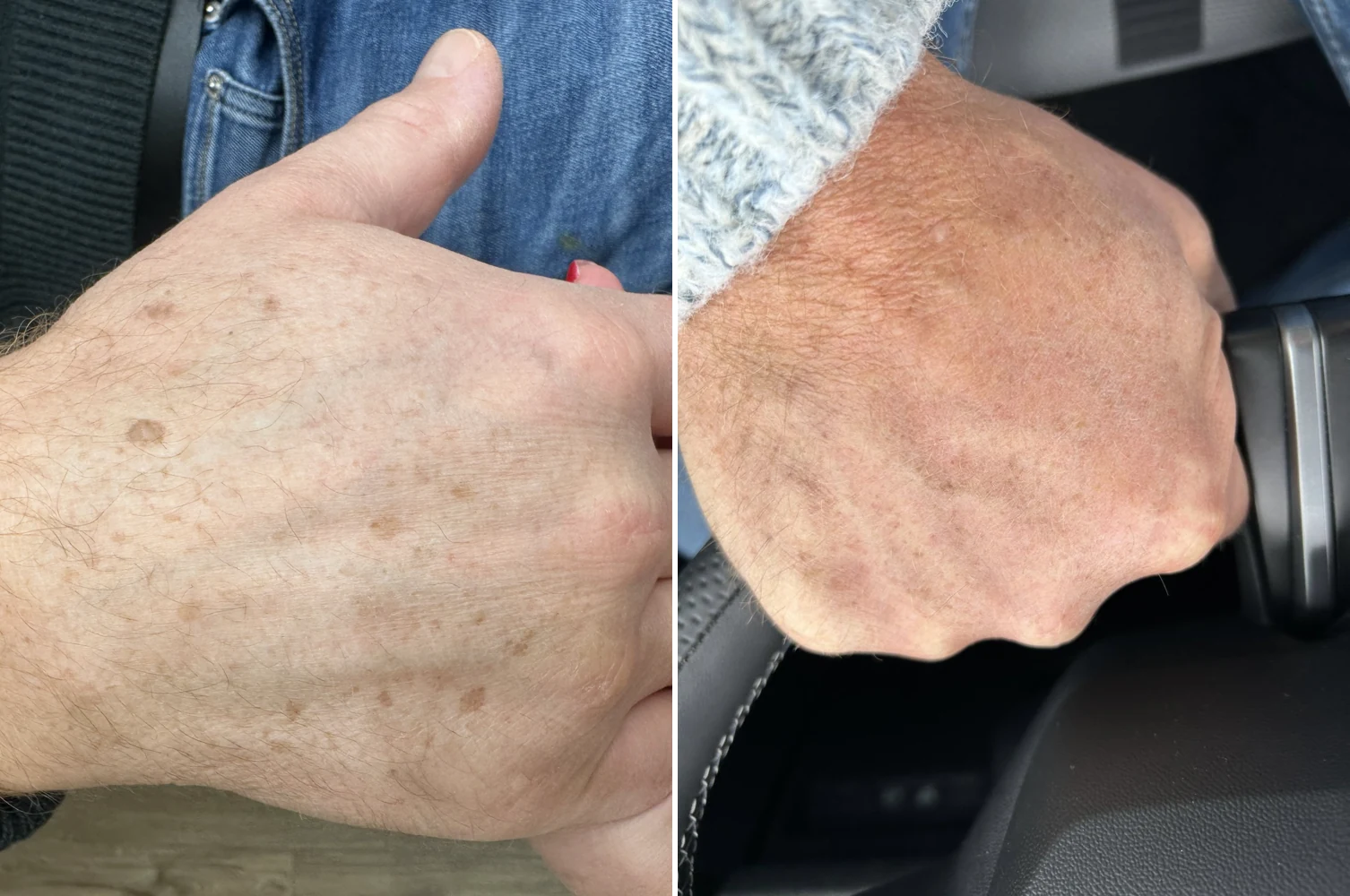 CryoPen before and after — age spots on the hands cleared at Beauty Studio MediSpa, Shenfield