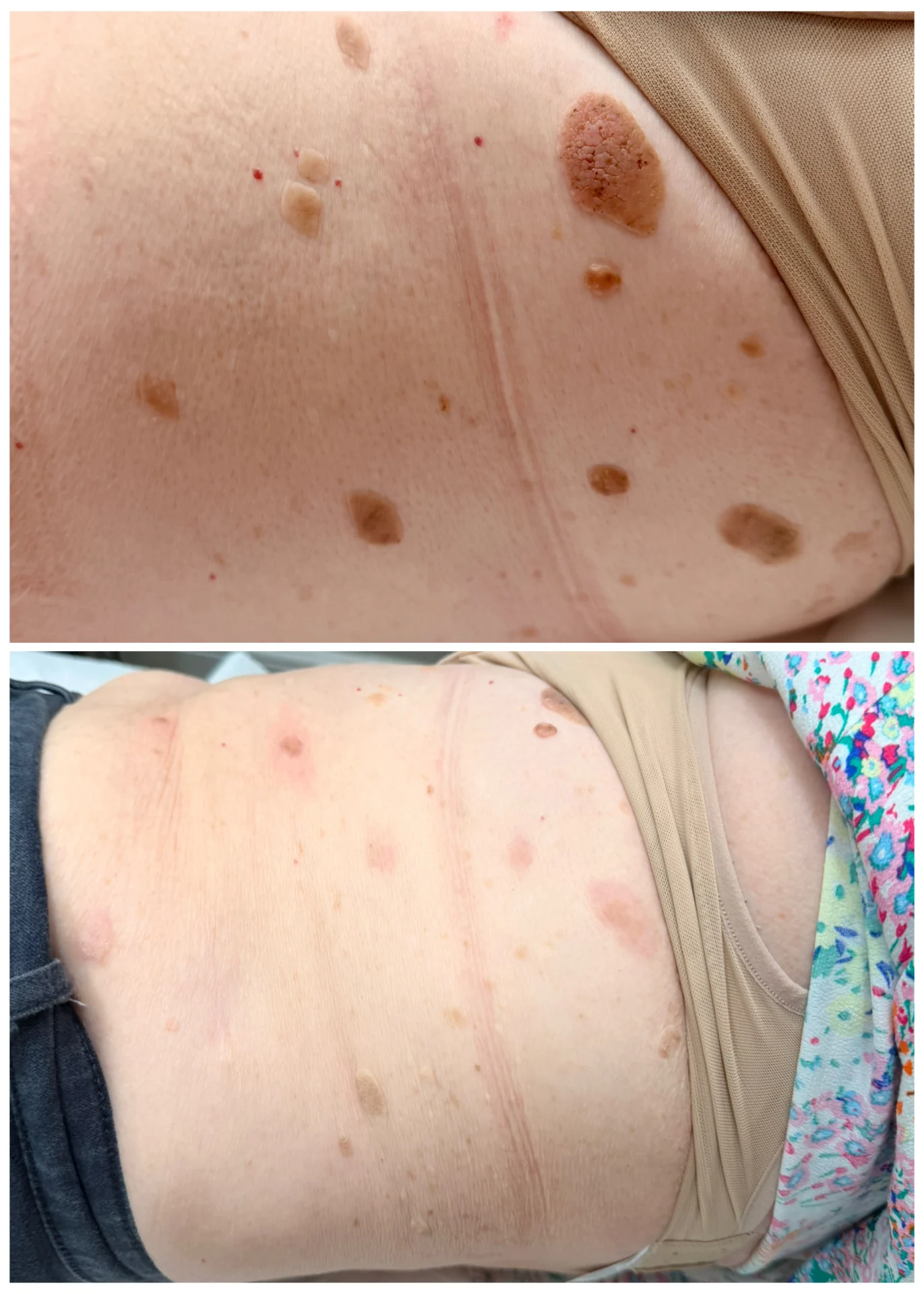 CryoPen before and after at Beauty Studio MediSpa, Shenfield