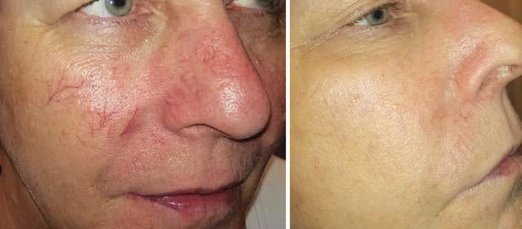 CoolGlide laser vein treatment before and after (facial thread veins) at Beauty Studio MediSpa, Shenfield