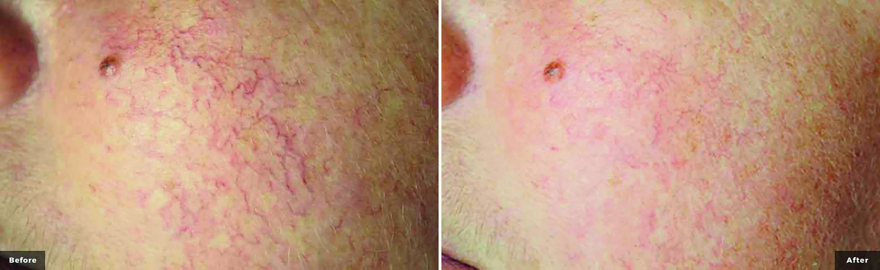 CoolGlide laser vein treatment before and after (facial veins) at Beauty Studio MediSpa, Shenfield