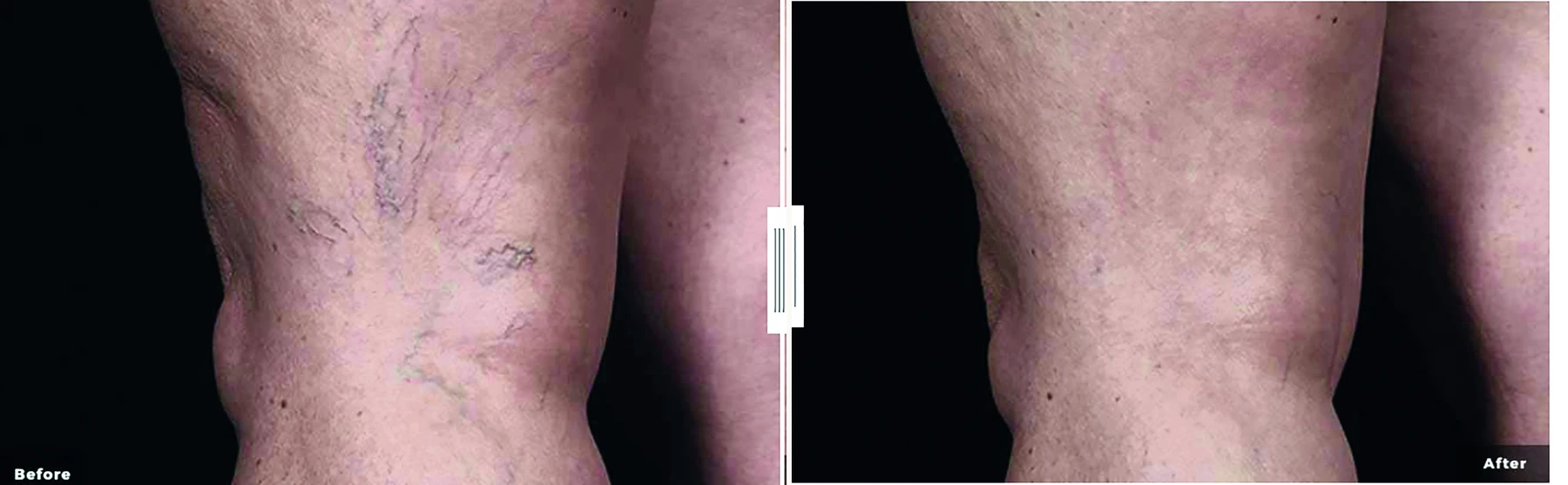 CoolGlide laser vein treatment before and after (body veins) at Beauty Studio MediSpa, Shenfield