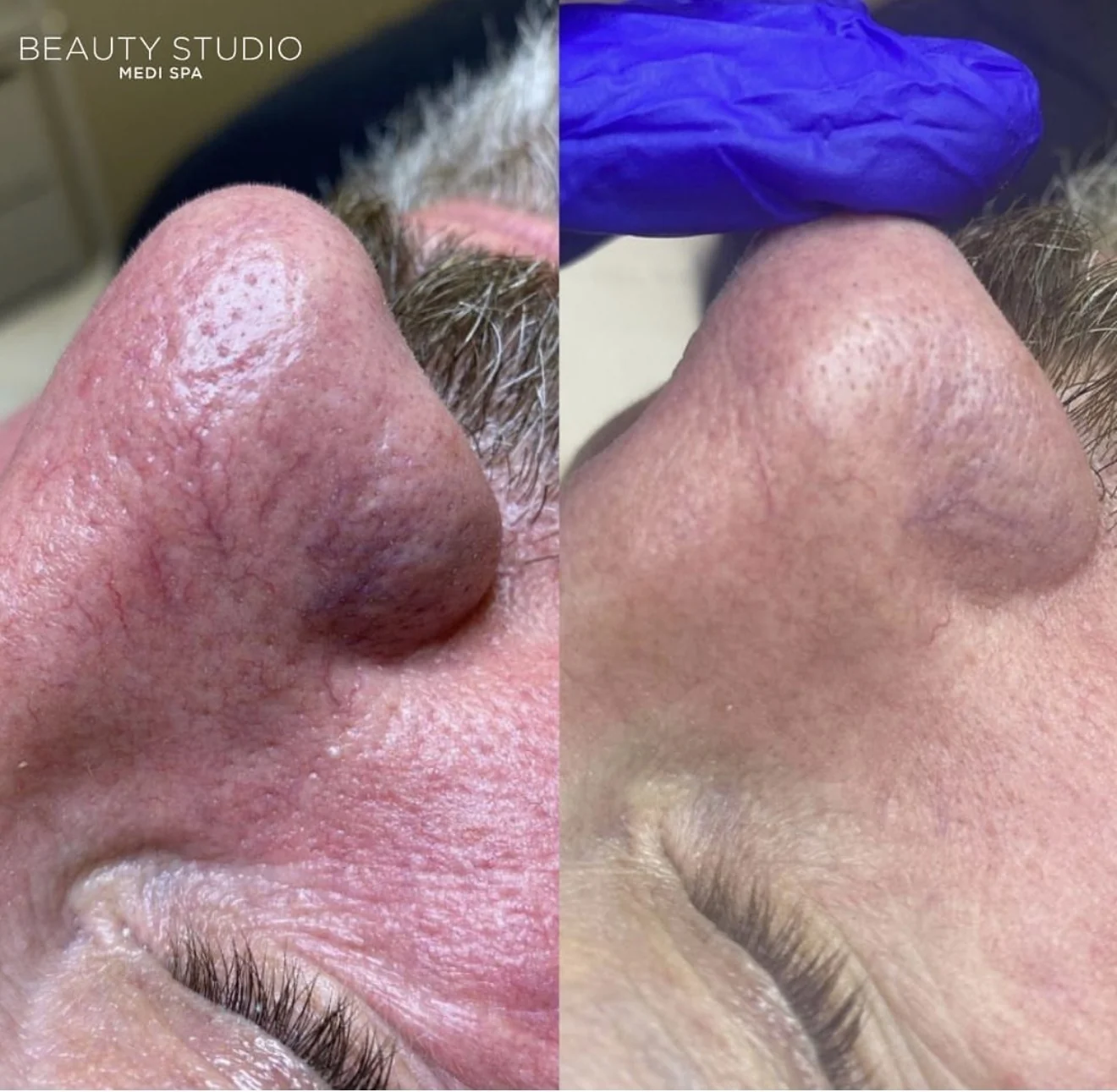 Cutera CoolGlide before and after at Beauty Studio MediSpa, Shenfield