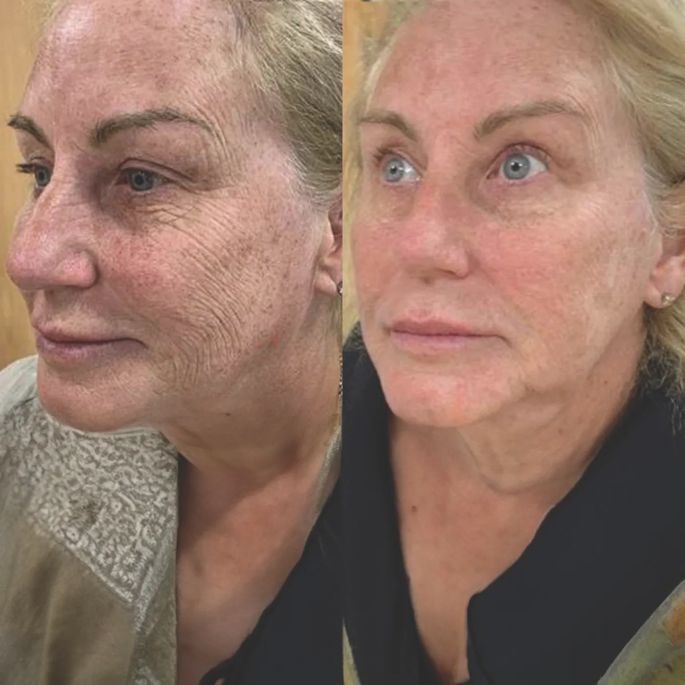 E50 Exosomes before and after at Beauty Studio MediSpa, Shenfield