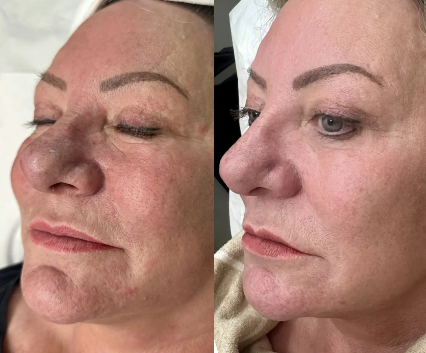 E50 Exosomes before and after at Beauty Studio MediSpa, Shenfield