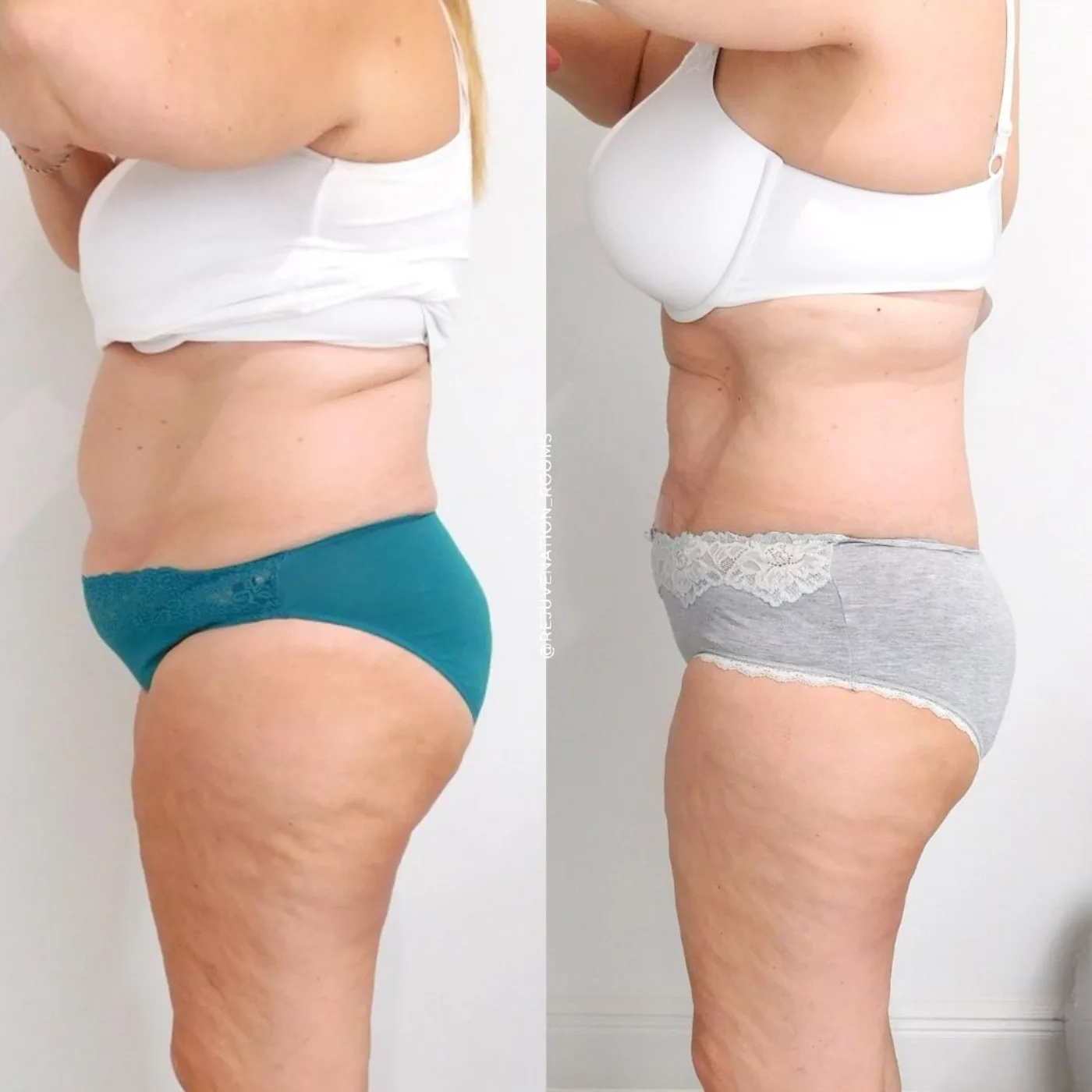 Emerald Laser fat reduction before and after at Beauty Studio MediSpa, Shenfield