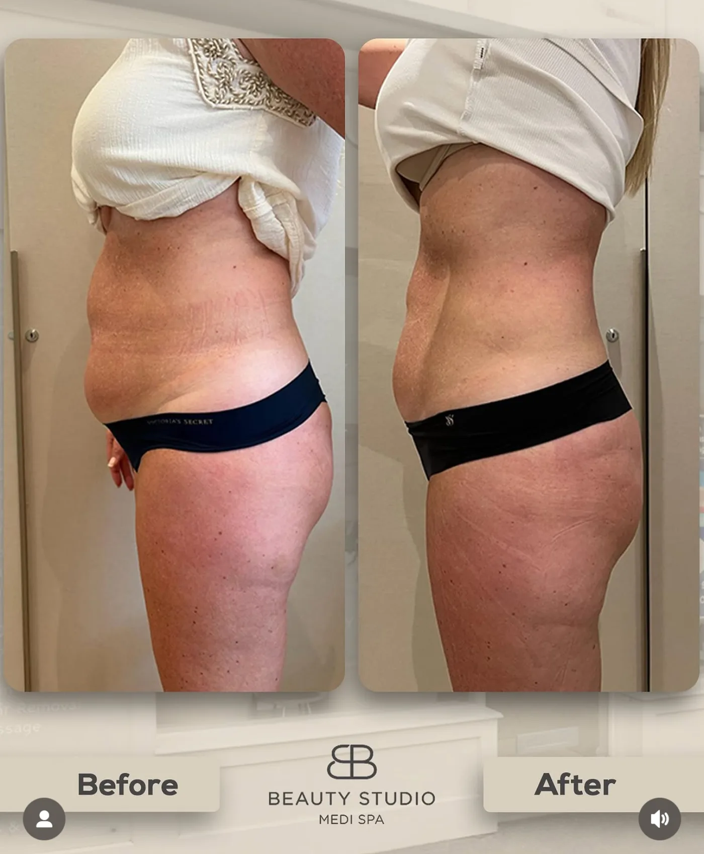 Emerald Laser fat reduction before and after at Beauty Studio MediSpa, Shenfield
