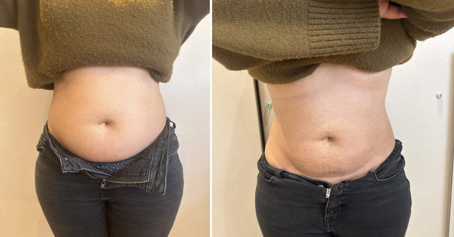 Emerald Laser before and after (abdomen inch loss) at Beauty Studio MediSpa, Shenfield