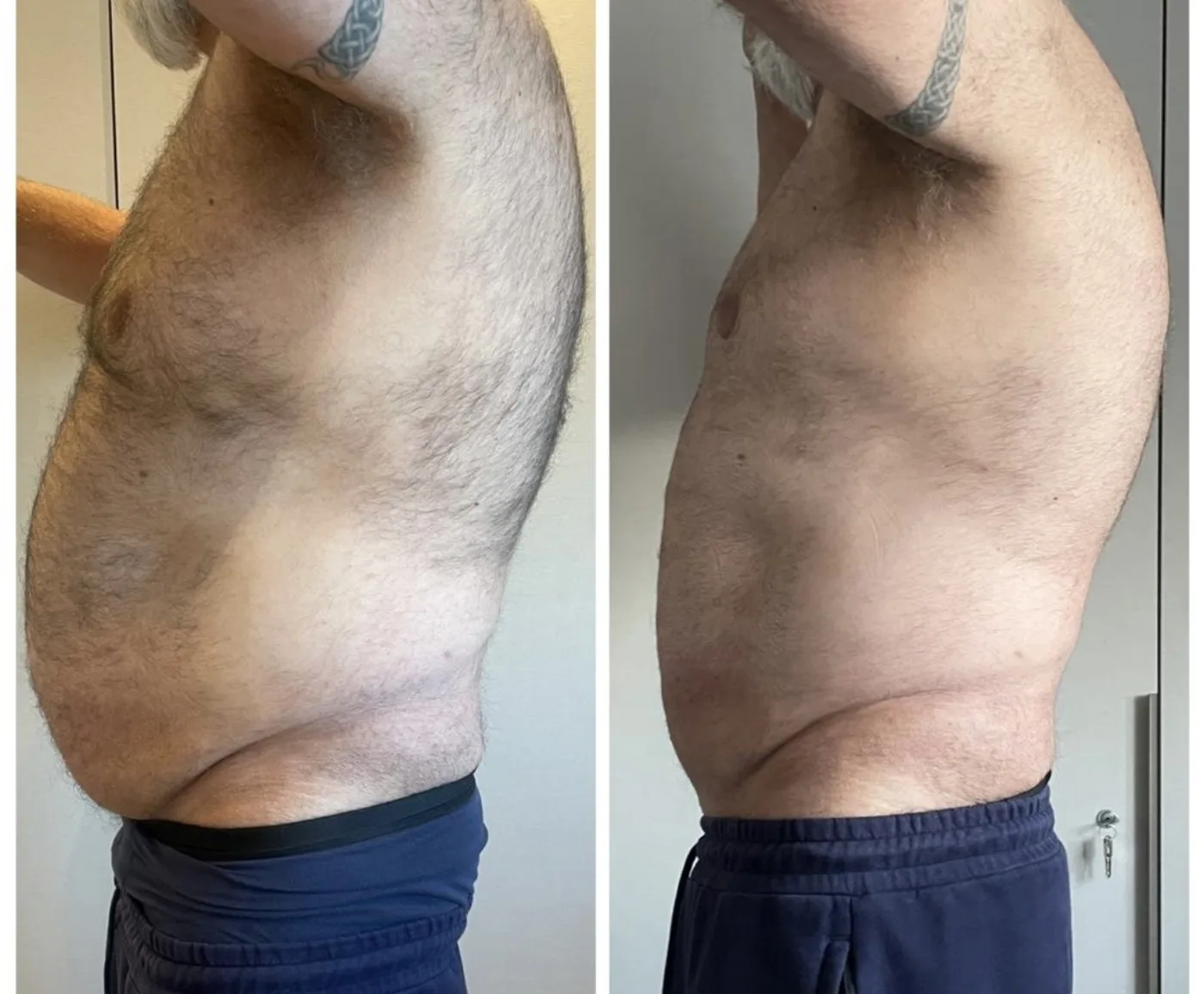 Emerald Laser fat reduction before and after at Beauty Studio MediSpa, Shenfield
