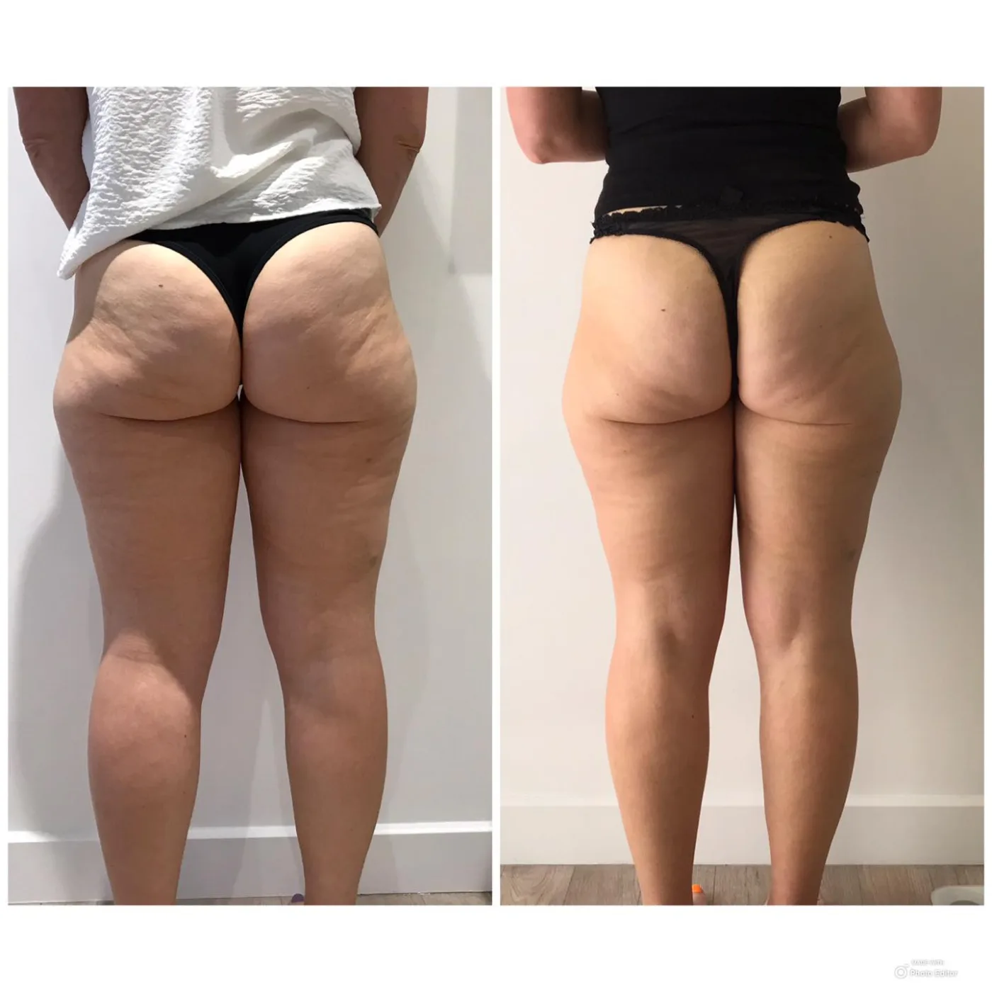 Emerald Laser fat reduction before and after at Beauty Studio MediSpa, Shenfield