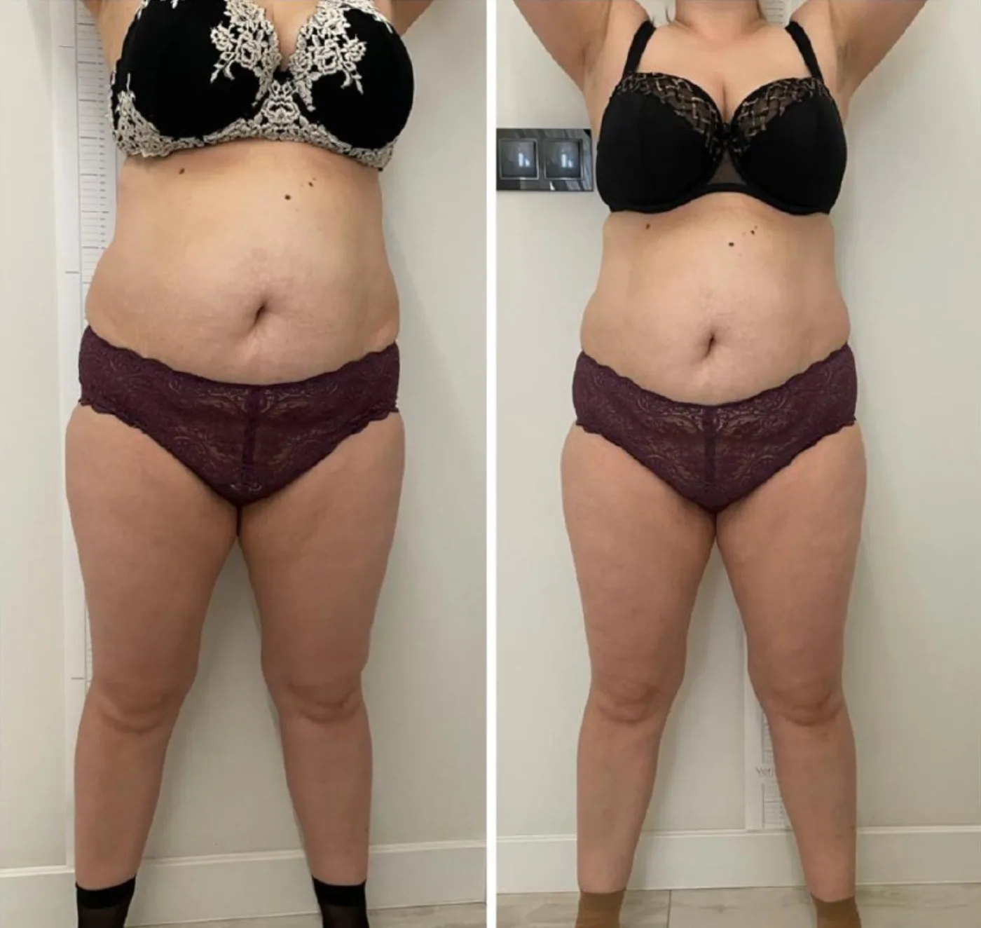 Emerald Laser fat reduction before and after at Beauty Studio MediSpa, Shenfield