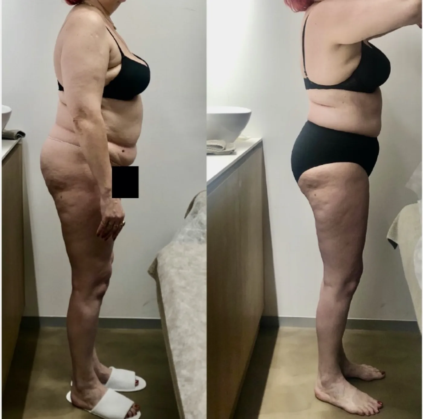 Emerald Laser fat reduction before and after at Beauty Studio MediSpa, Shenfield