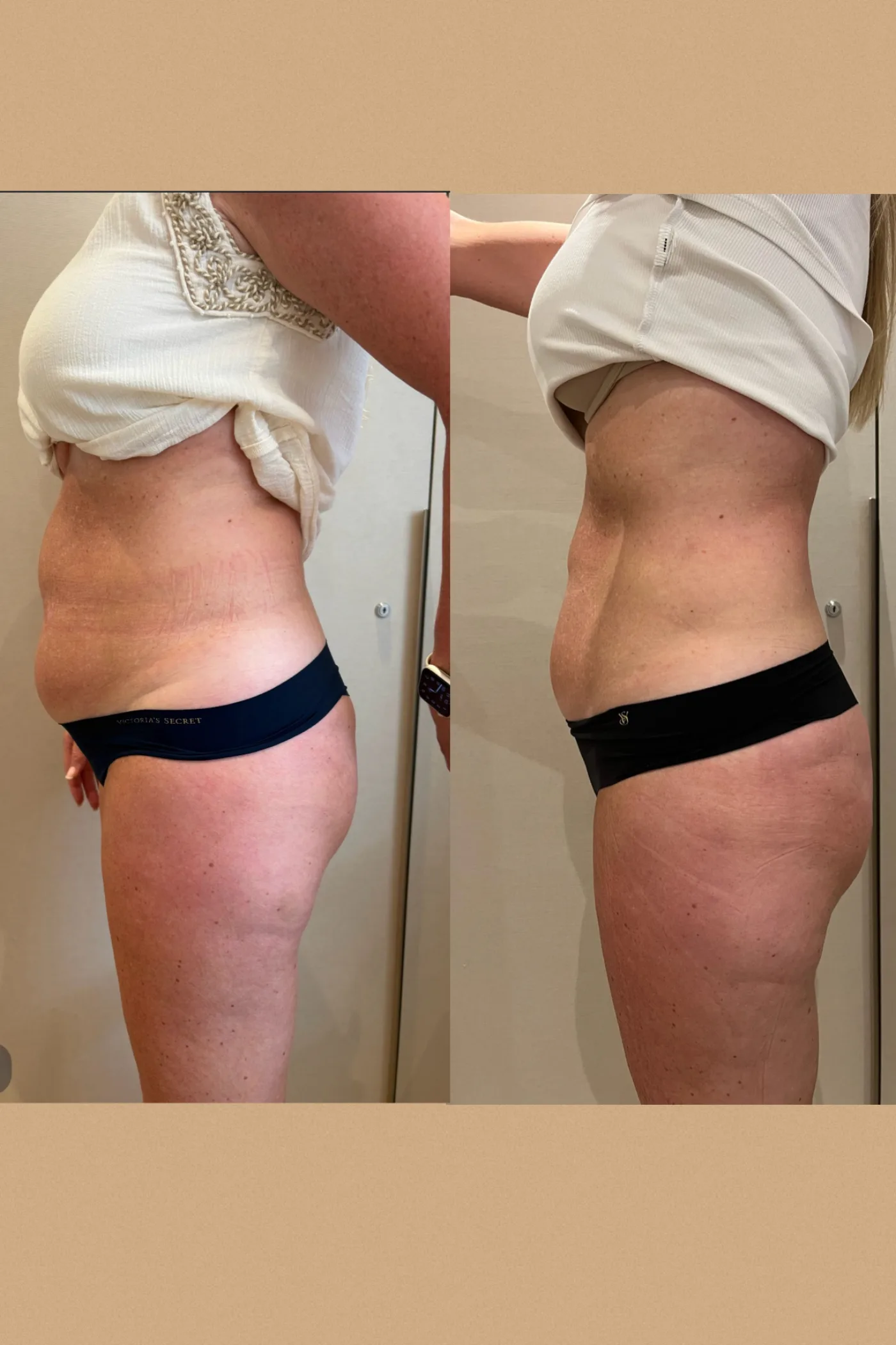 Emerald Laser fat reduction before and after at Beauty Studio MediSpa, Shenfield