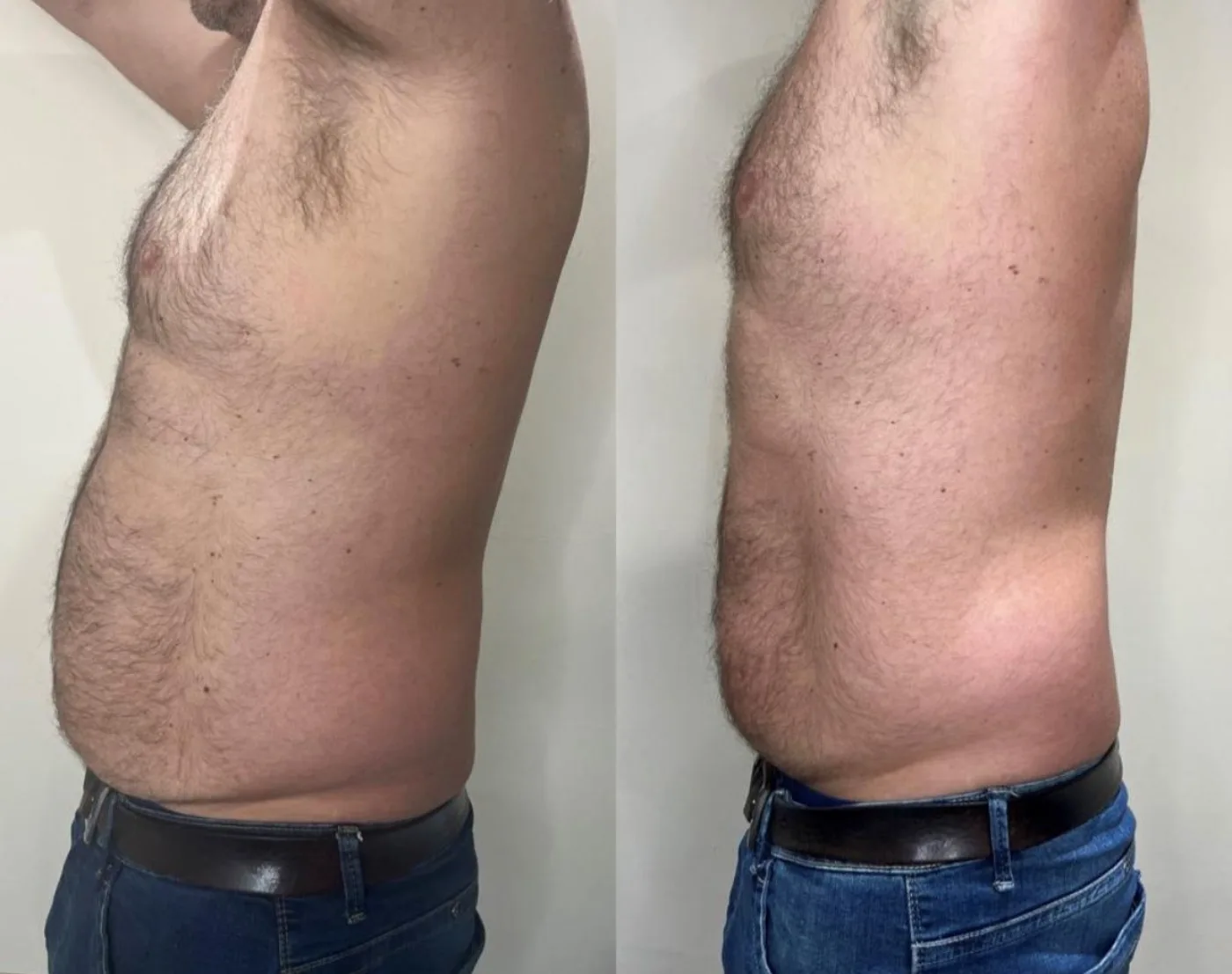 Emerald Laser fat reduction before and after at Beauty Studio MediSpa, Shenfield