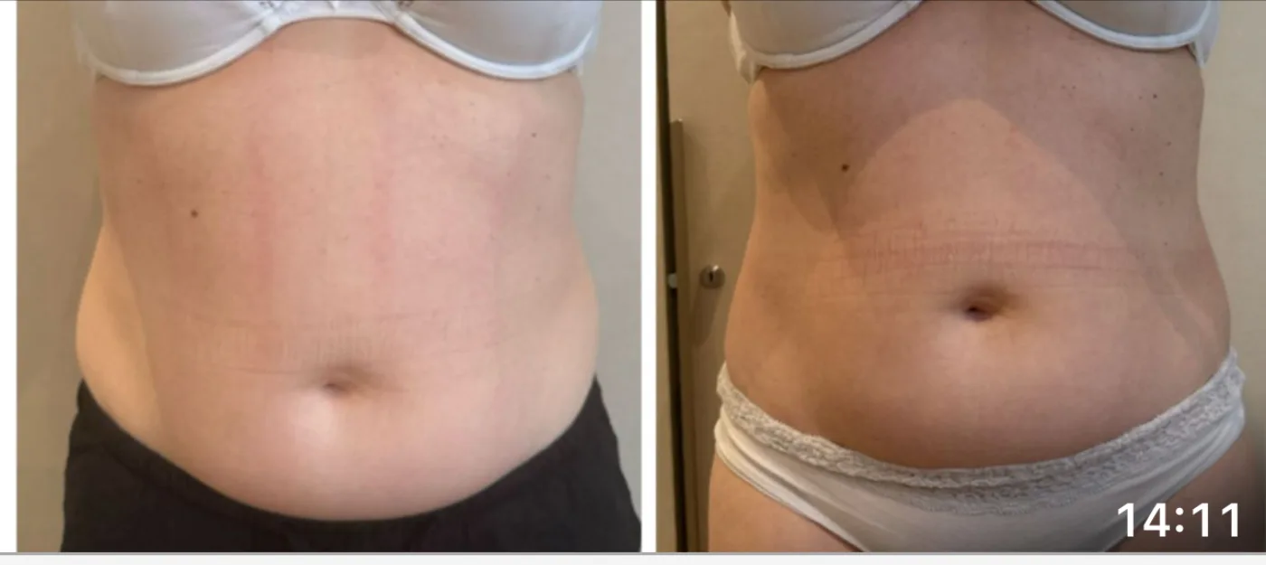 Emerald Laser fat reduction before and after at Beauty Studio MediSpa, Shenfield
