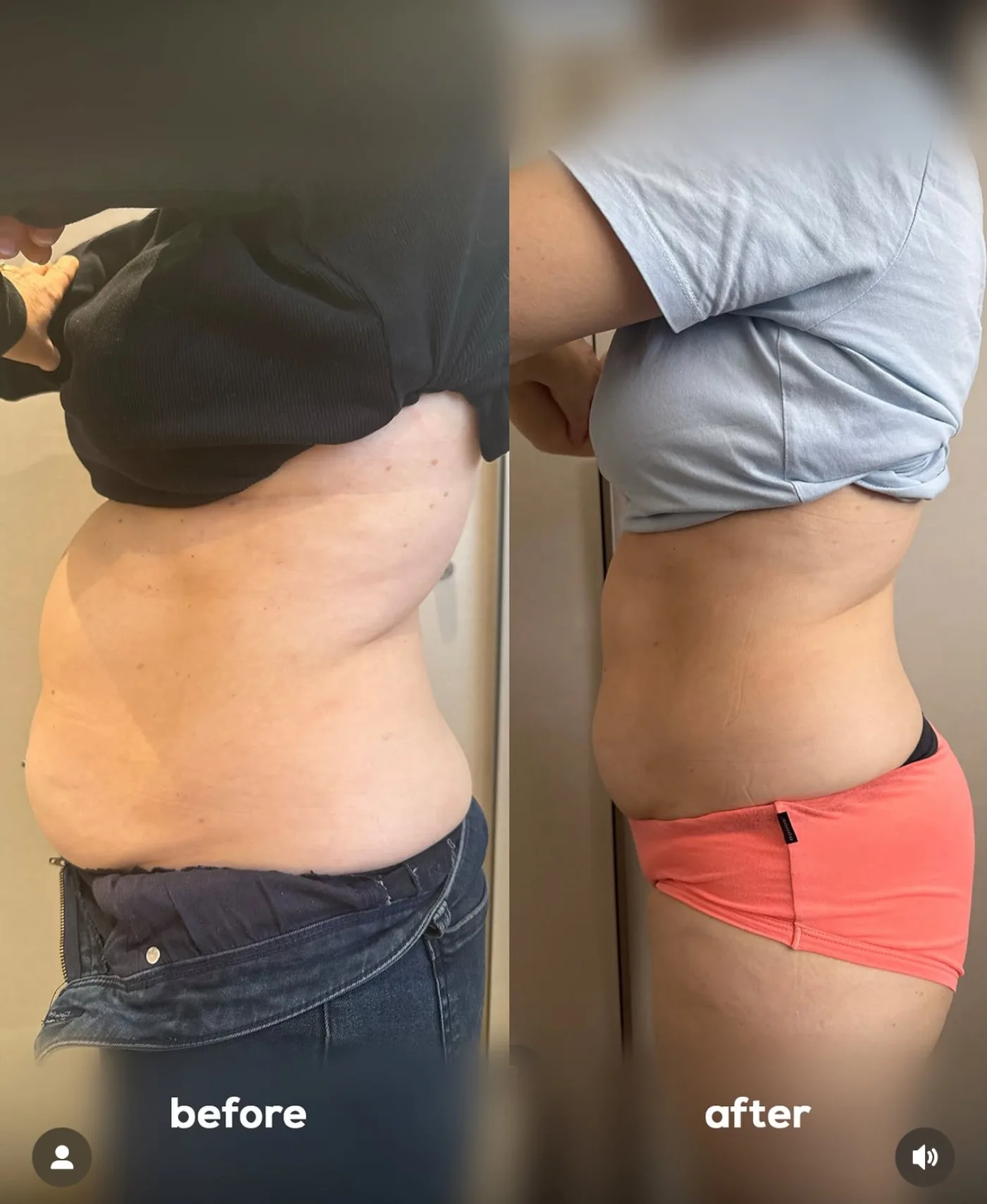 Emerald Laser fat reduction before and after at Beauty Studio MediSpa, Shenfield