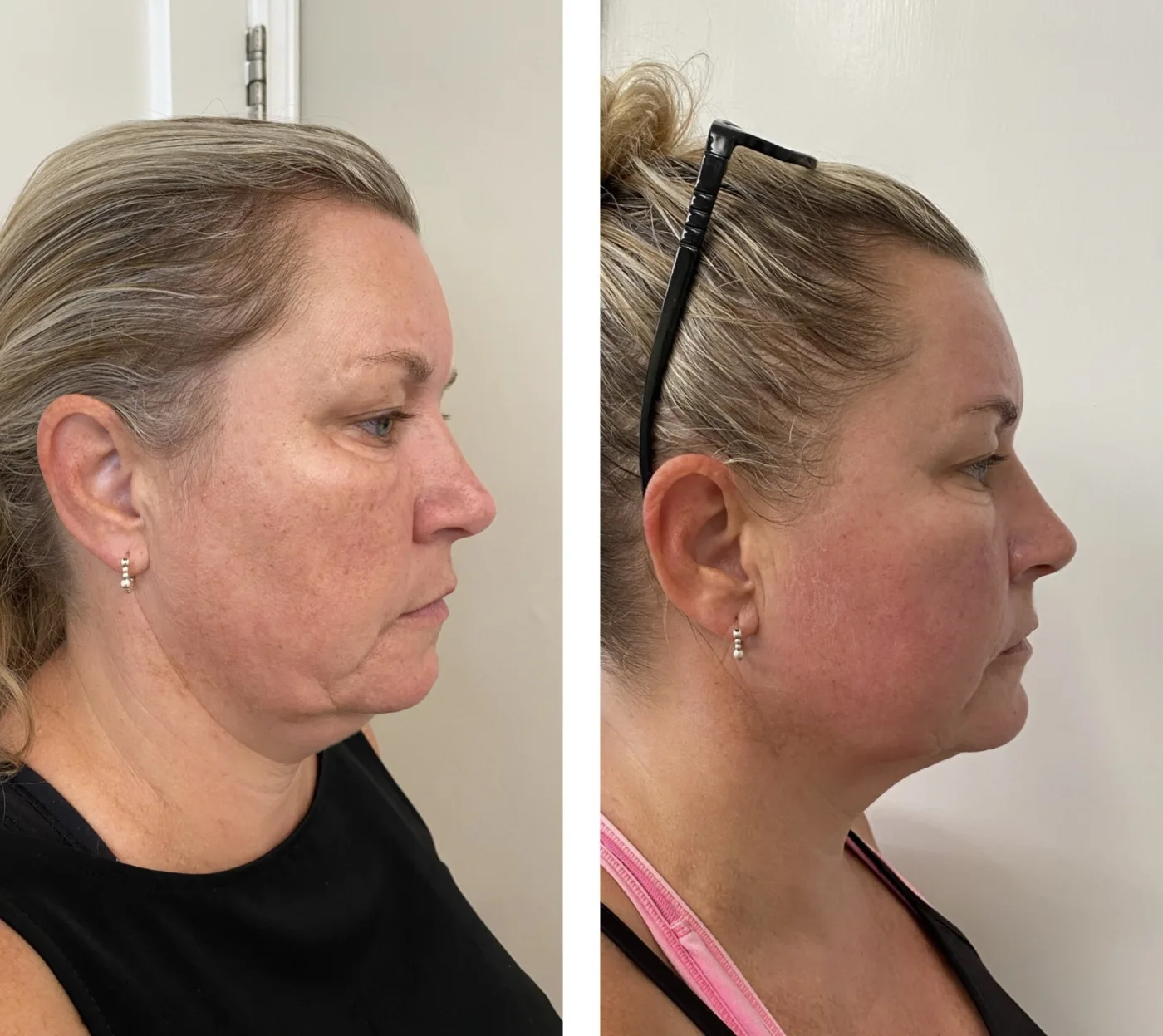 EMFACE before and after at Beauty Studio MediSpa, Shenfield