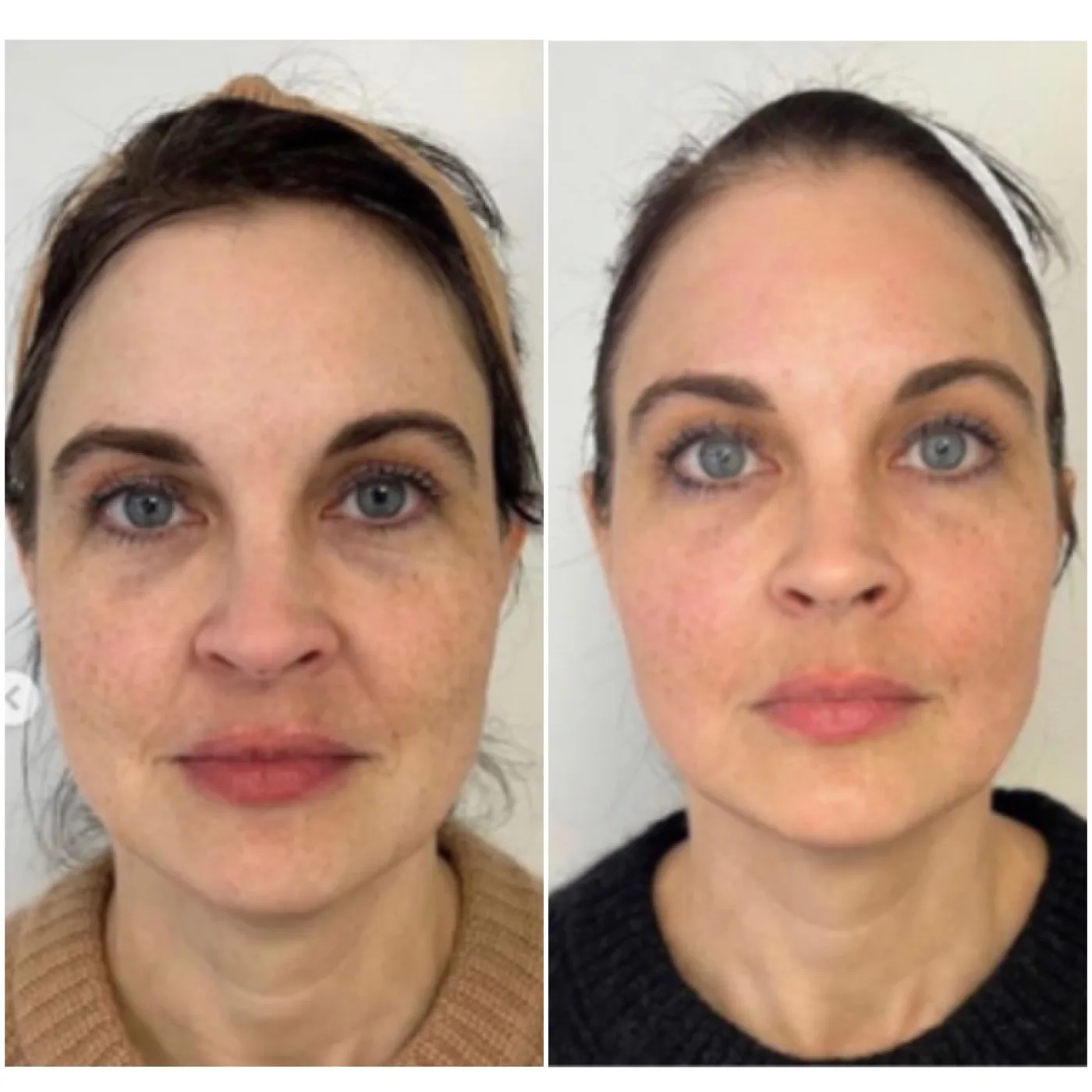 EMFACE before and after at Beauty Studio MediSpa, Shenfield