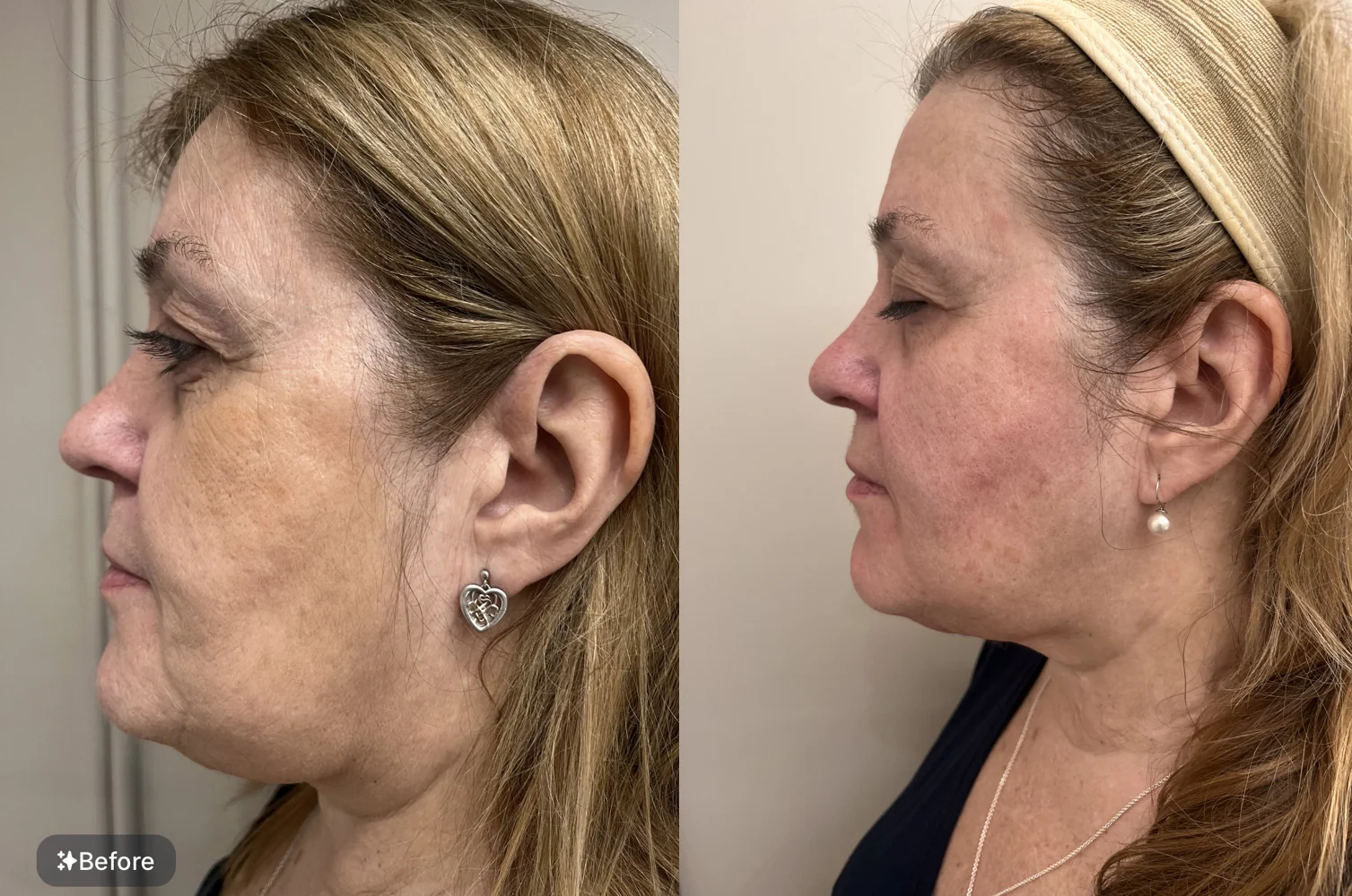 EMFACE before and after at Beauty Studio MediSpa, Shenfield