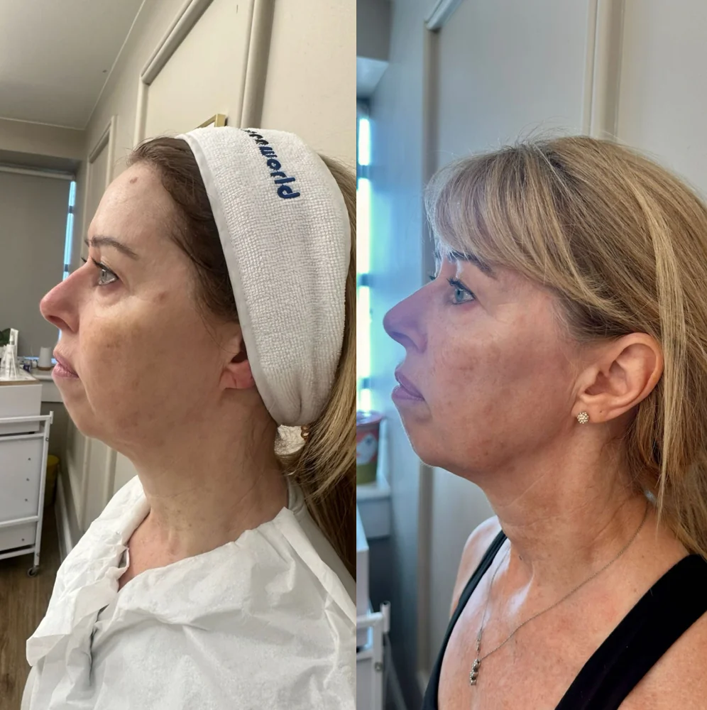 EMFACE before and after at Beauty Studio MediSpa, Shenfield