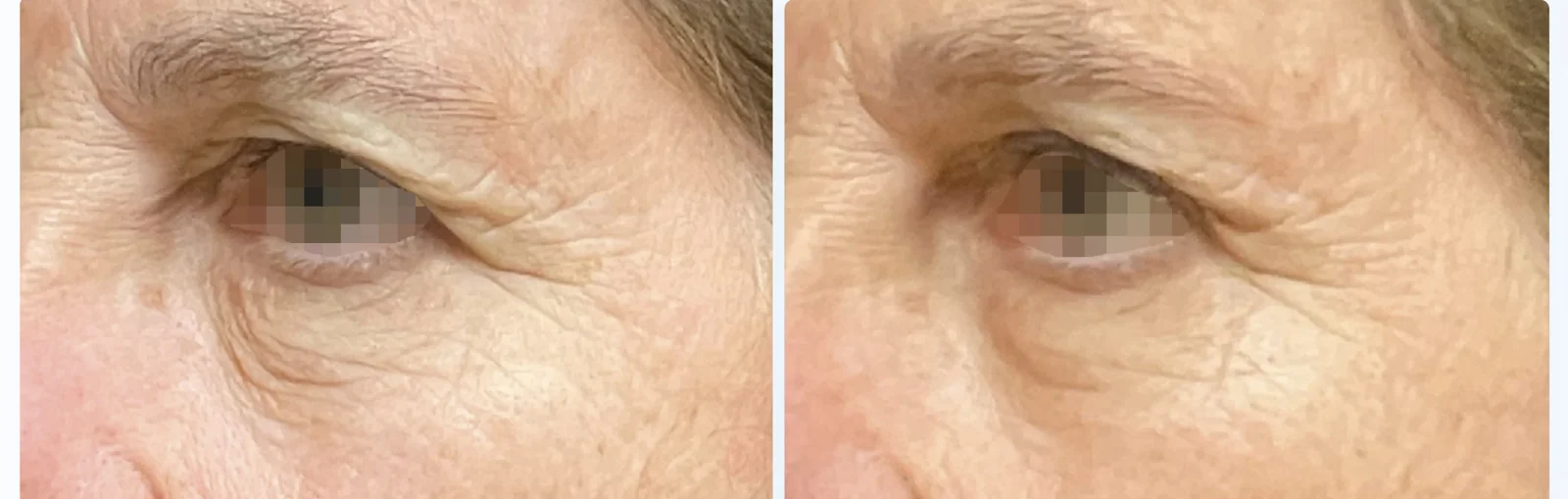 EMFACE before and after at Beauty Studio MediSpa, Shenfield
