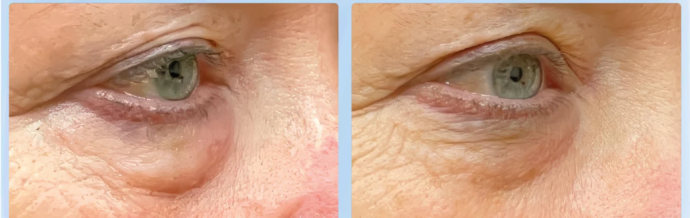 EMFace before and after at Beauty Studio MediSpa, Shenfield