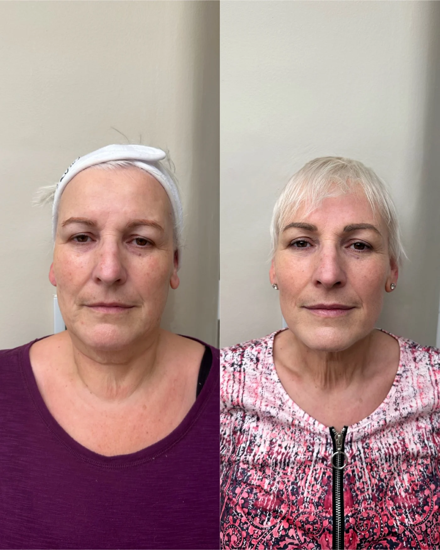 EMFace before and after at Beauty Studio MediSpa, Shenfield