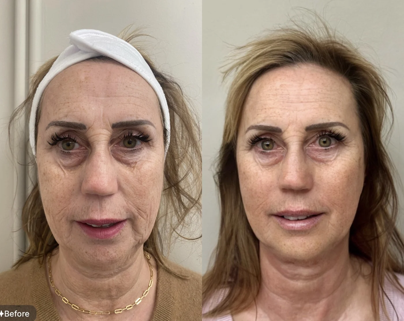 EMFace before and after at Beauty Studio MediSpa, Shenfield