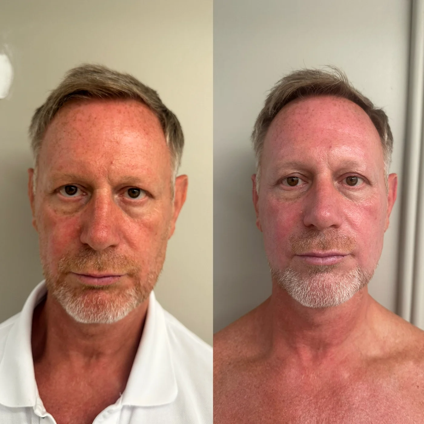 EMFace before and after at Beauty Studio MediSpa, Shenfield