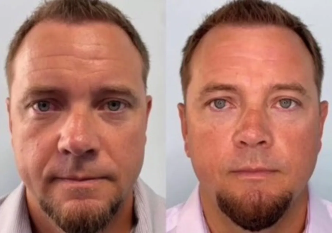 EMFACE before and after at Beauty Studio MediSpa, Shenfield