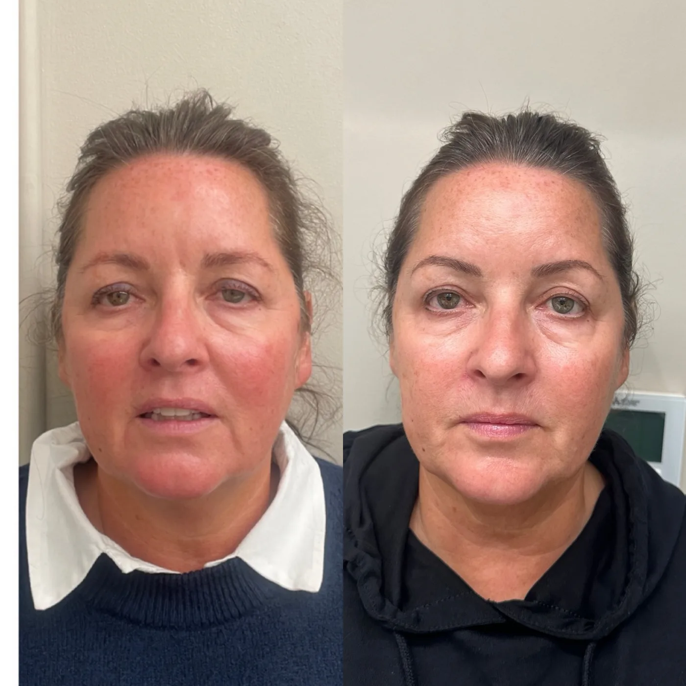 EMFACE before and after at Beauty Studio MediSpa, Shenfield