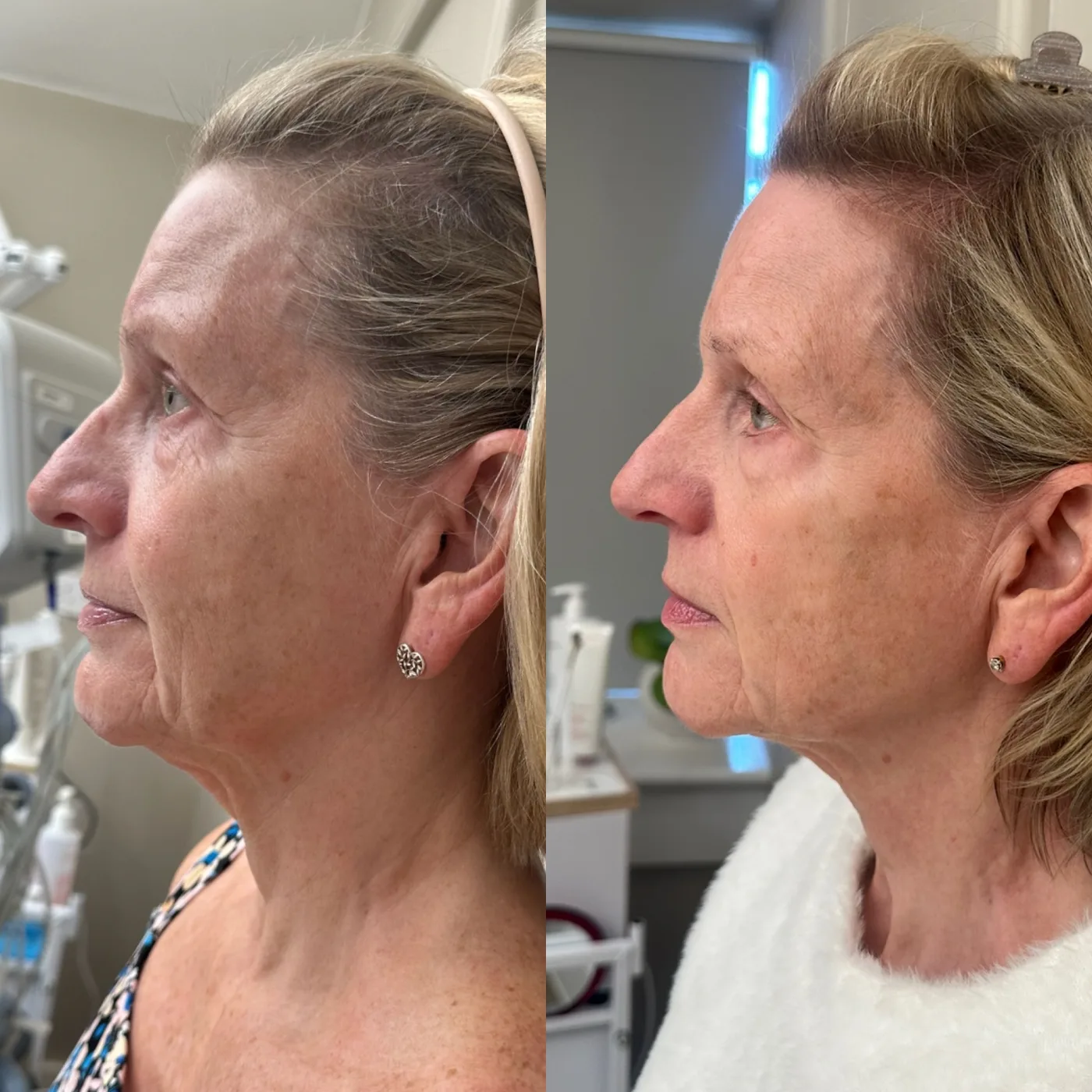 EMFACE before and after at Beauty Studio MediSpa, Shenfield