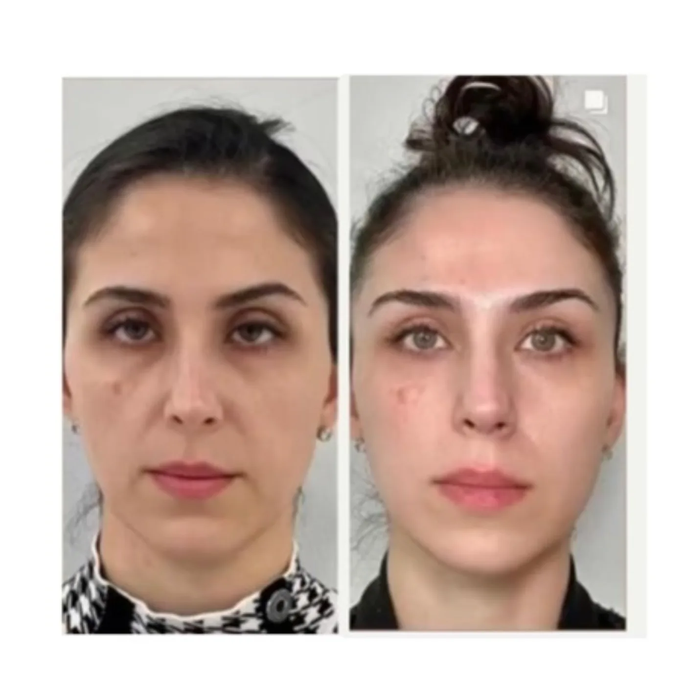 EMFACE before and after at Beauty Studio MediSpa, Shenfield