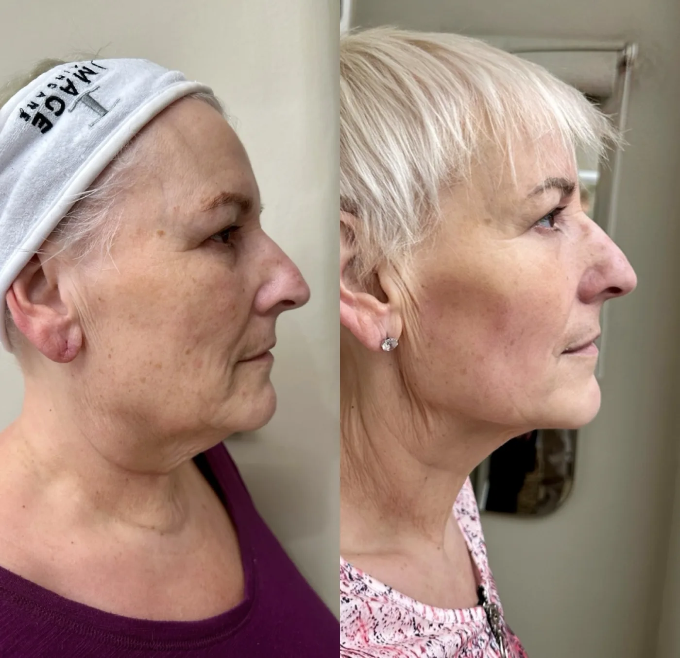 EMFACE before and after at Beauty Studio MediSpa, Shenfield
