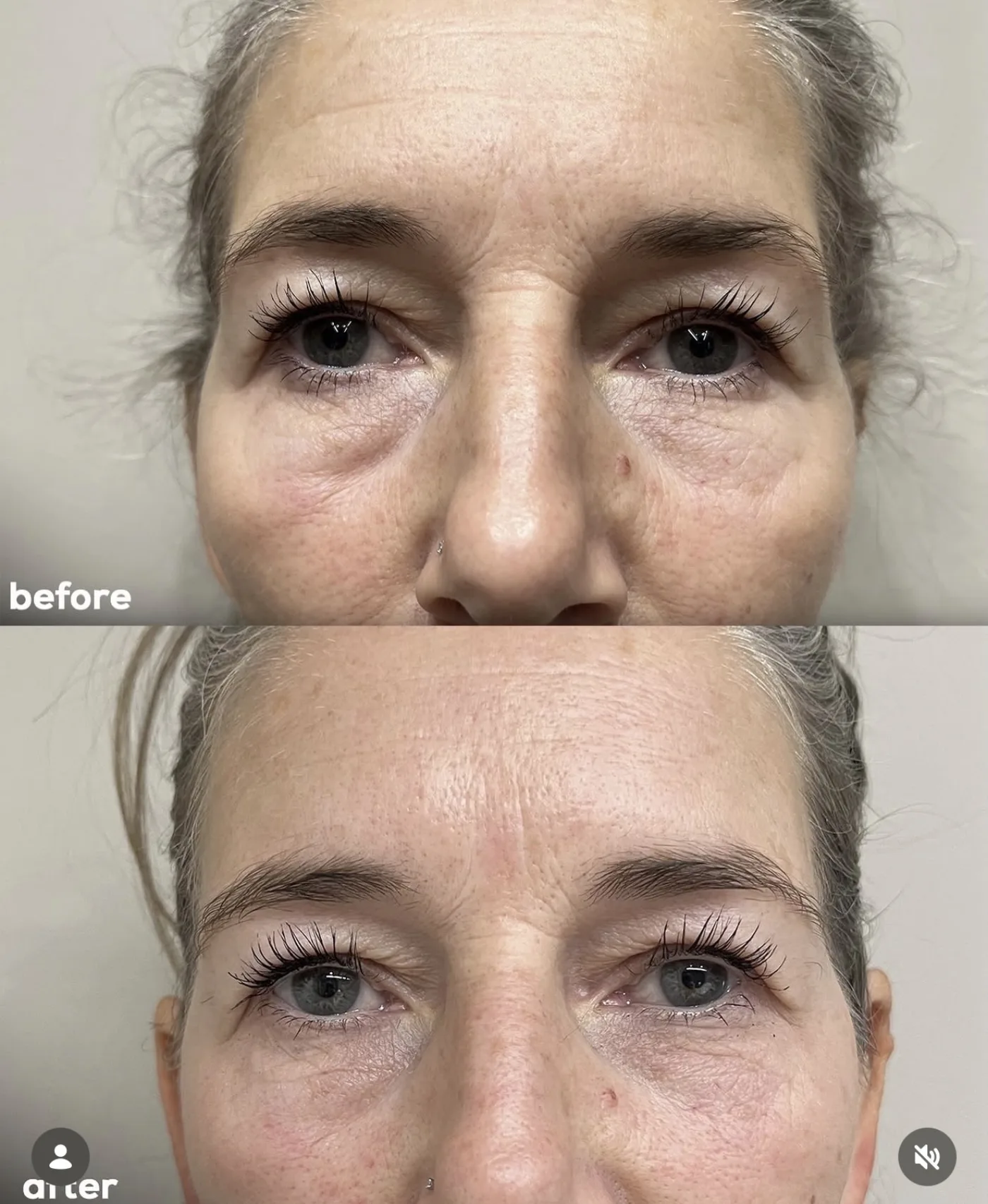 EMFACE before and after at Beauty Studio MediSpa, Shenfield