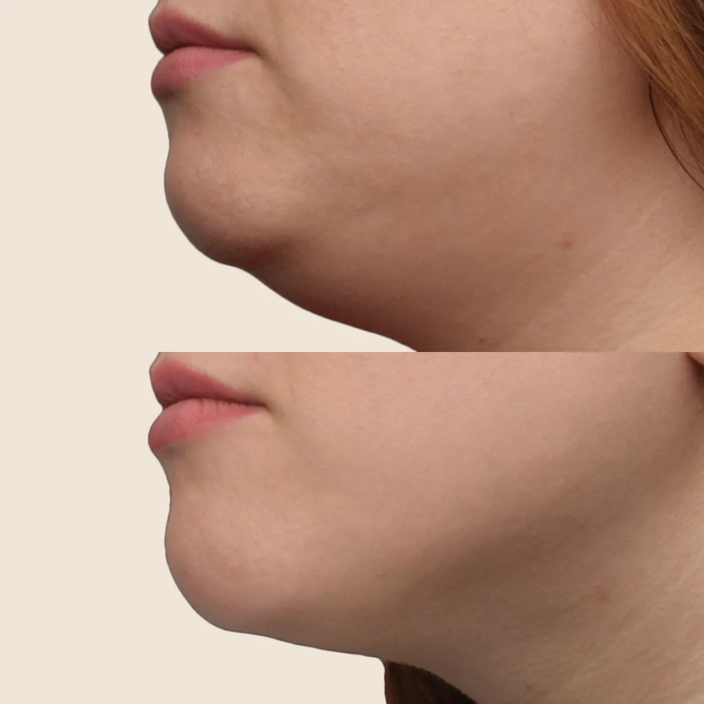 EMFACE before and after at Beauty Studio MediSpa, Shenfield