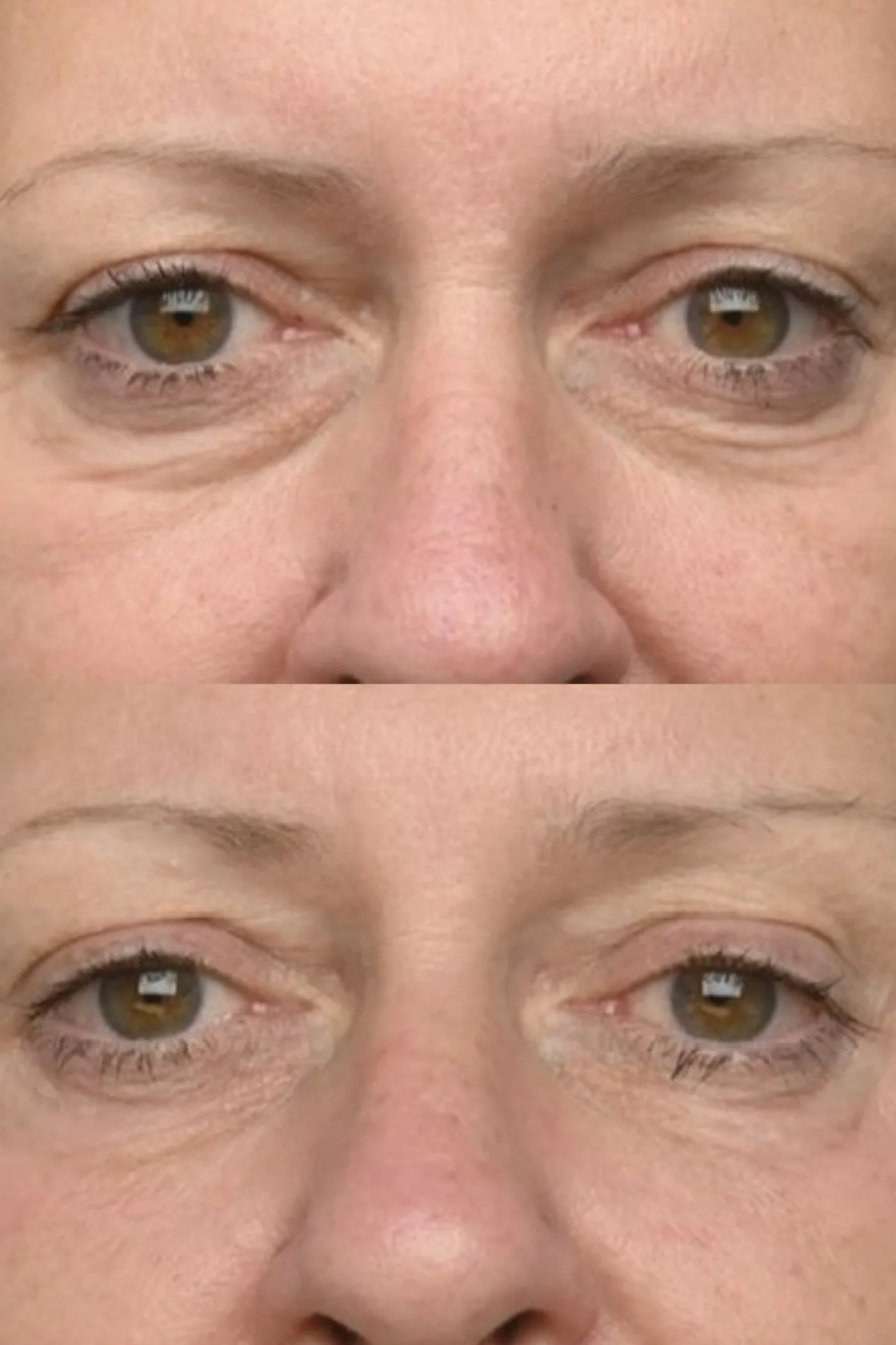 EMFACE before and after at Beauty Studio MediSpa, Shenfield