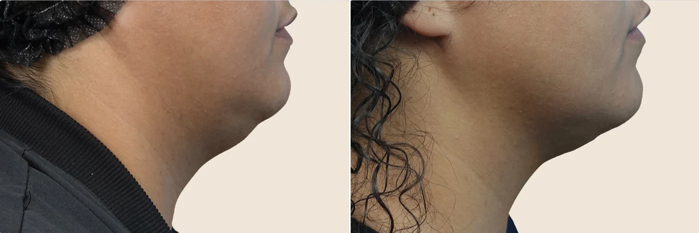 EMFace before and after at Beauty Studio MediSpa, Shenfield