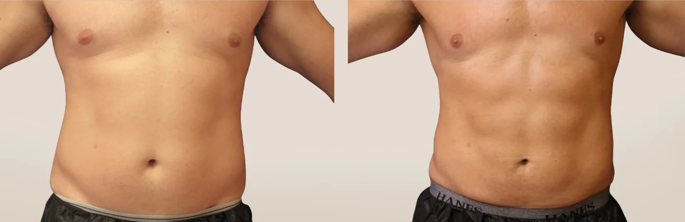 EMSCULPT NEO body sculpting before and after at Beauty Studio MediSpa, Shenfield