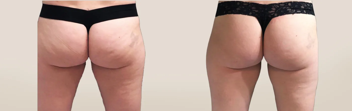 EMSCULPT NEO body sculpting before and after at Beauty Studio MediSpa, Shenfield