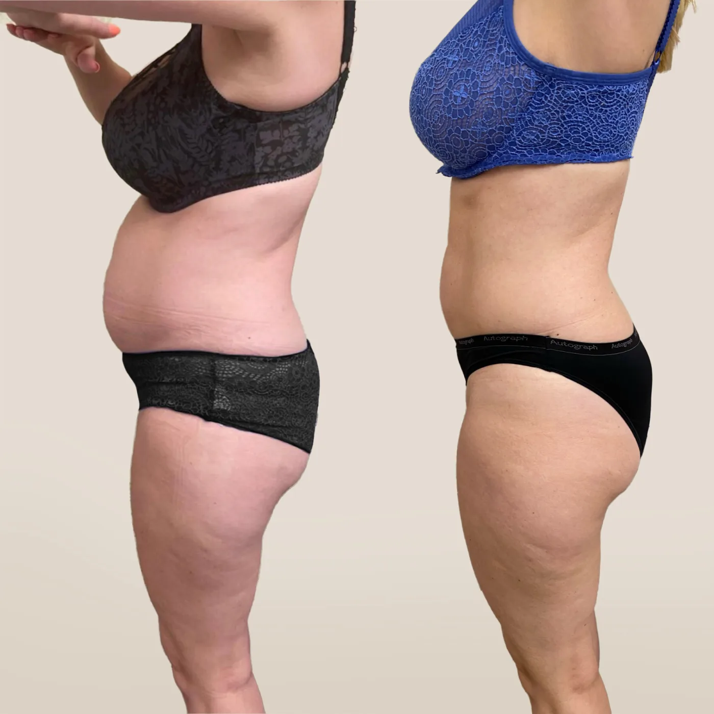 EMSCULPT NEO body sculpting before and after at Beauty Studio MediSpa, Shenfield