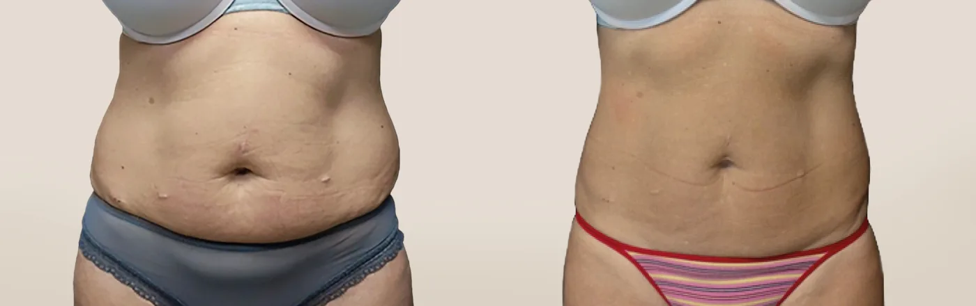 EMSCULPT NEO body sculpting before and after at Beauty Studio MediSpa, Shenfield
