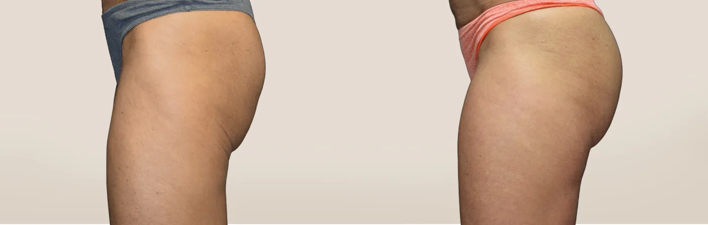 EMSCULPT NEO body sculpting before and after at Beauty Studio MediSpa, Shenfield