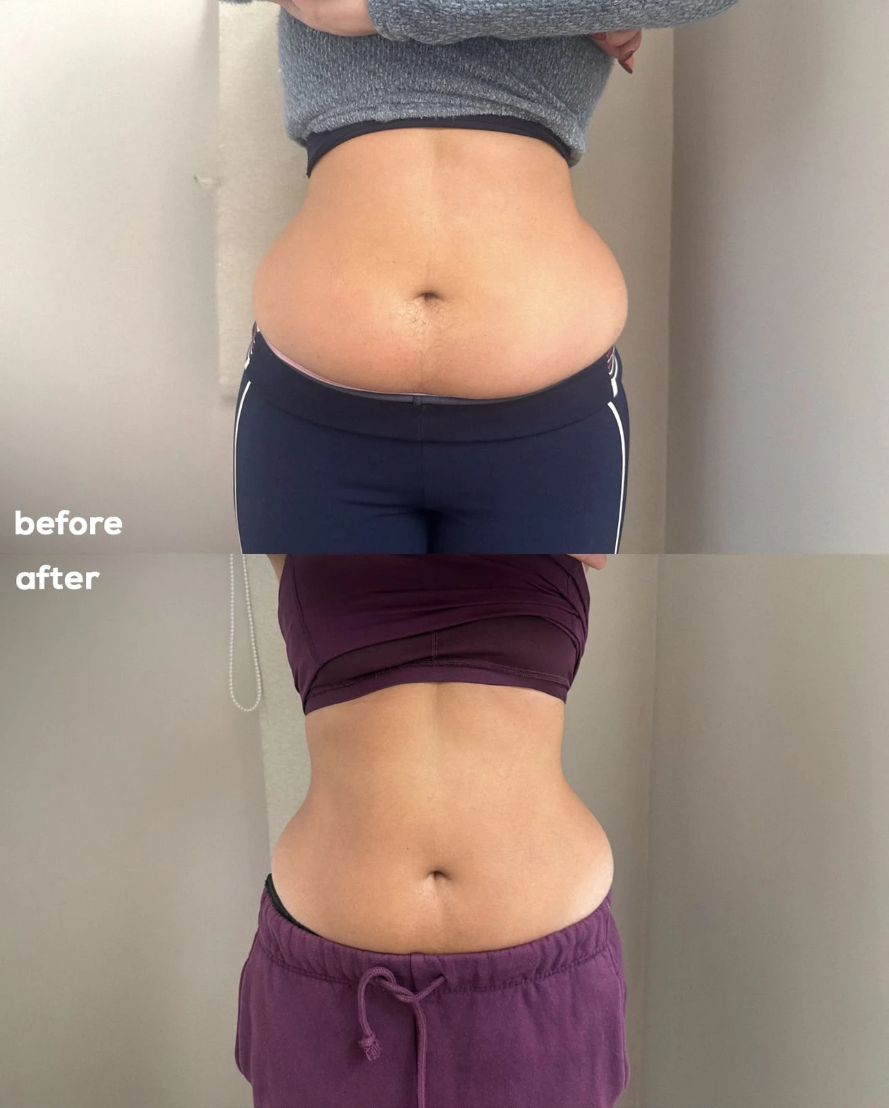 EMSCULPT NEO before and after at Beauty Studio MediSpa, Shenfield