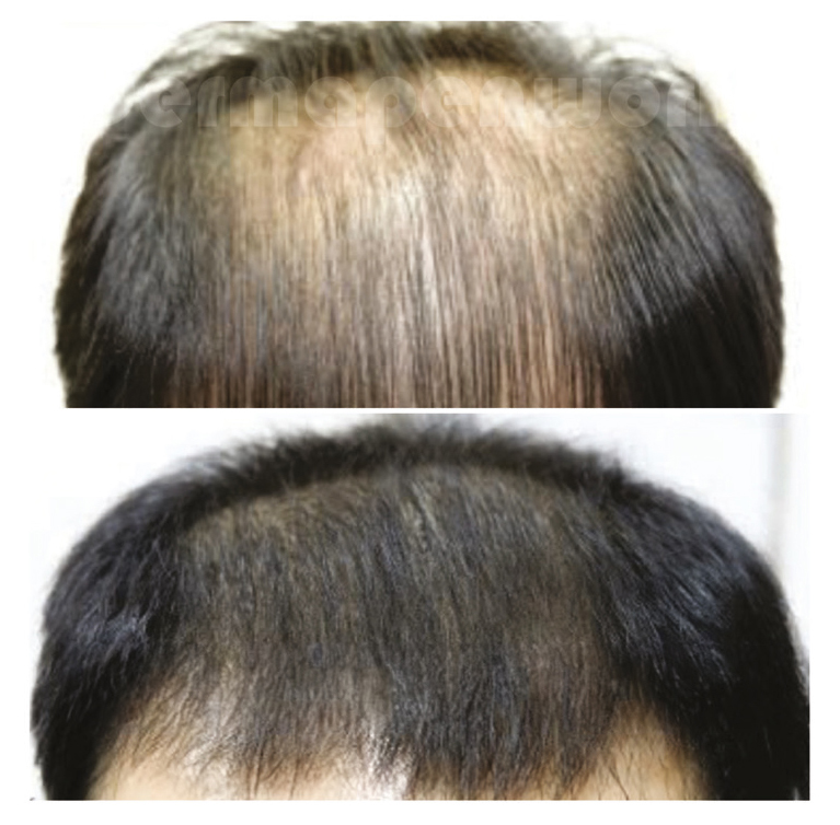 ExoGrow Hair Restoration before and after at Beauty Studio MediSpa, Shenfield