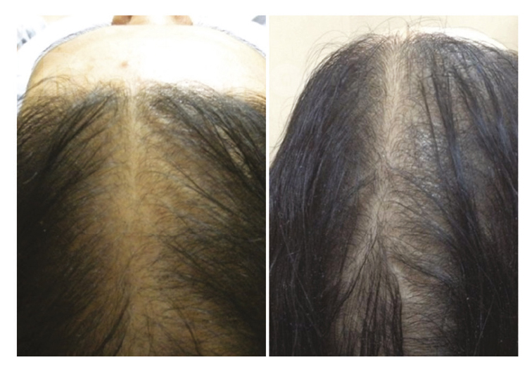 ExoGrow Hair Restoration before and after at Beauty Studio MediSpa, Shenfield